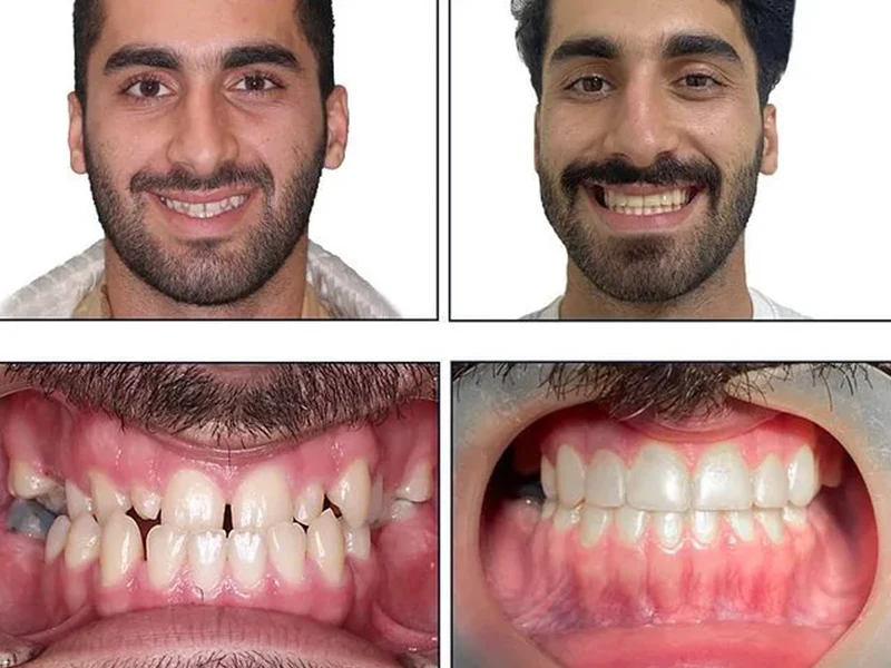 آیا ارتودنسی بر فرم صورت تاثیر می گذارد؟
