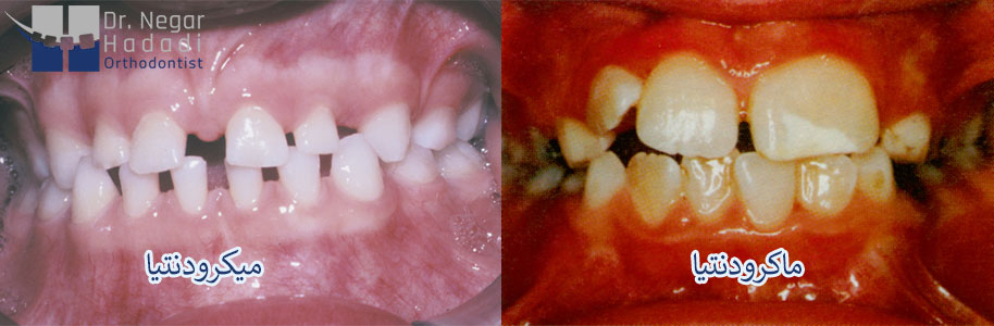 ناهنجاری های مرتبط با اندازه دندان
