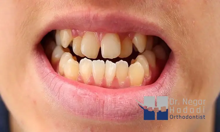 چگونه از کج شدن دندان جلوگیری کنیم؟