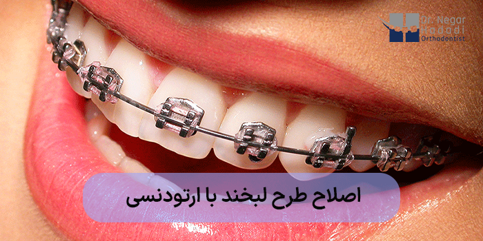 اصلاح طرح لبخند با ارتودنسی