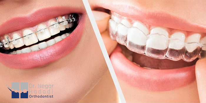 آیا در زمان ارتودنسی میتوان از روشهای سفید کردن دندانها استفاده کرد؟