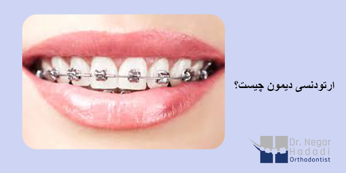 ارتودنسی دیمون و تفاوت آن با سایر بریس ها