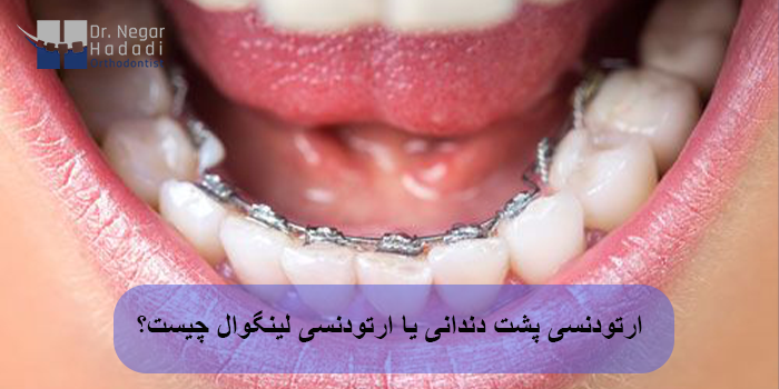 ارتودنسی پشت دندانی یا ارتودنسی لینگوال