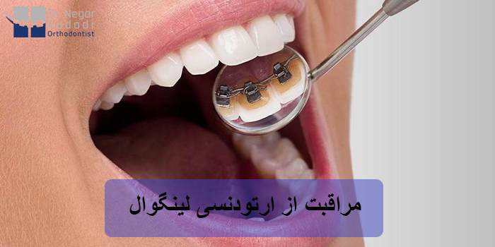 مراقبت از ارتودنسی لینگوال