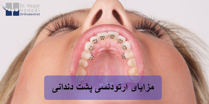 مزایای ارتودنسی پشت دندانی