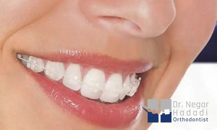 ارتودنسی سرامیکی چیست؟