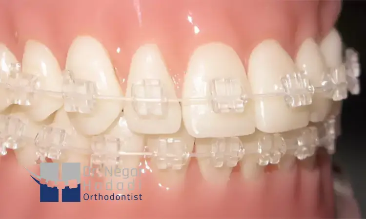 ارتودنسی سرامیکی برای چه افرادی مناسب است؟