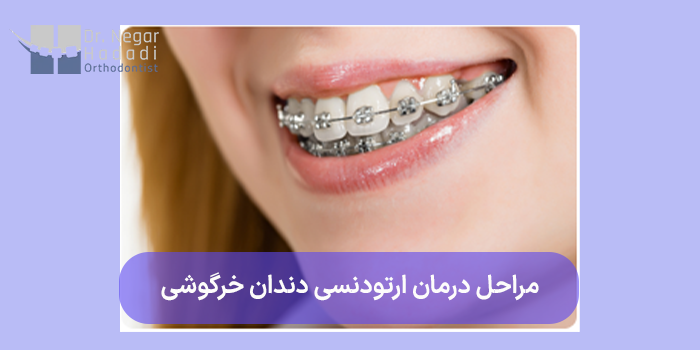 مراحل درمان ارتودنسی دندان خرگوشی
