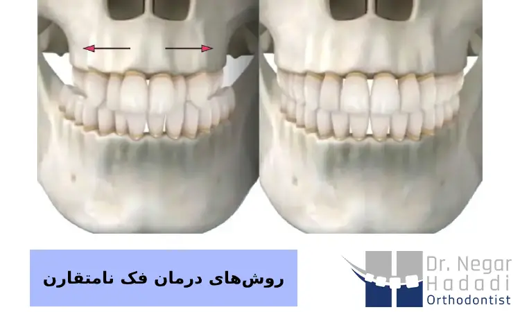 روش‌های تشخیص فک نامتقارن