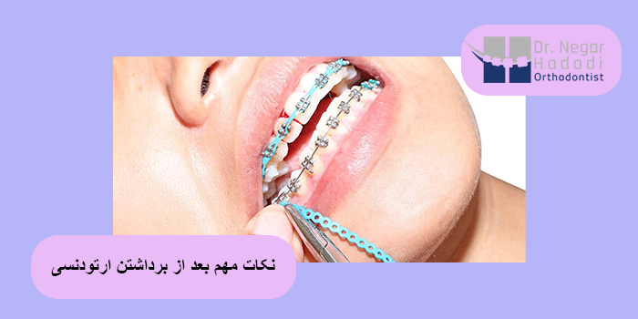 نکات مهم بعد از برداشتن ارتودنسی