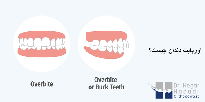 اوربایت دندان چیست؟