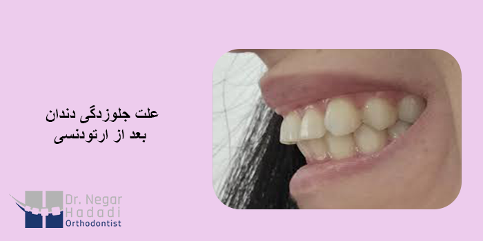 علت جلوزدگی دندان بعد از ارتودنسی