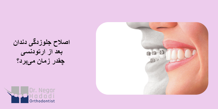 اصلاح جلوزدگی دندان بعد از ارتودنسی چقدر زمان میبرد؟