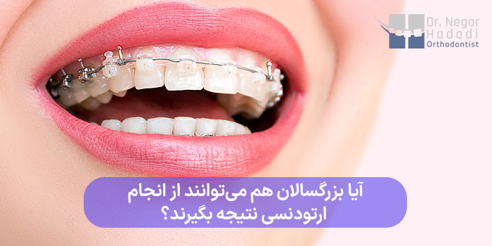 آیا بزرگسالان هم میتوانند از انجام ارتودنسی نتیجه بگیرند؟