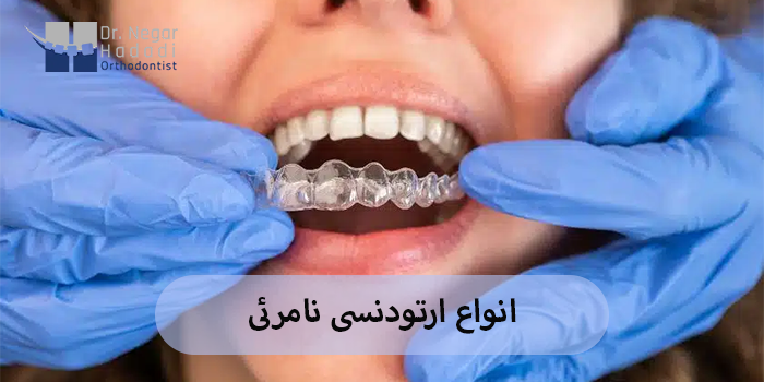 انواع ارتودنسی نامرئی