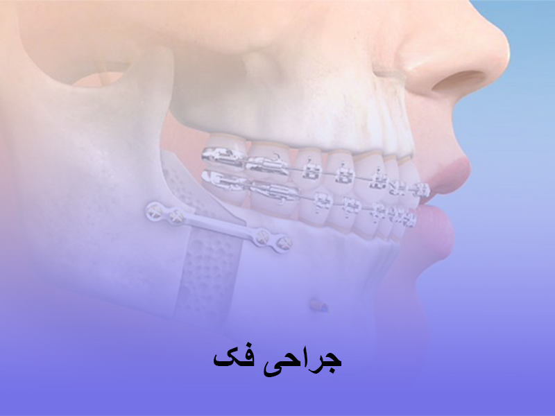 جراحی فک