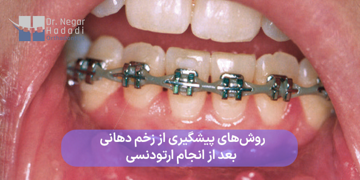 روشهای پیشگیری از زخم دهانی بعد از انجام ارتودنسی