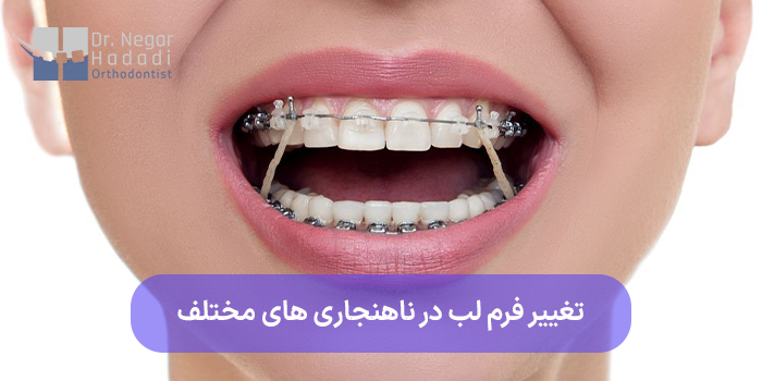 تغییر فرم لب در ناهنجاری های مختلف