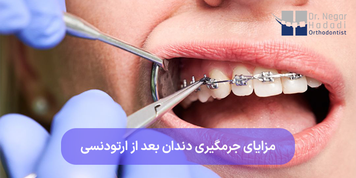 مزایای جرمگیری دندان بعد از ارتودنسی
