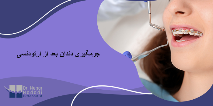 جرمگیری دندان بعد از ارتودنسی