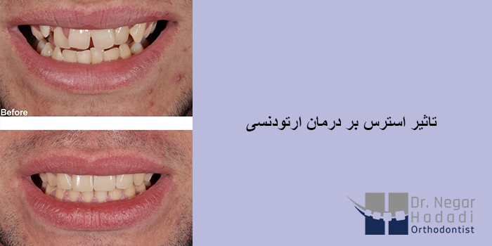 تاثیر استرس بر درمان ارتودنسی