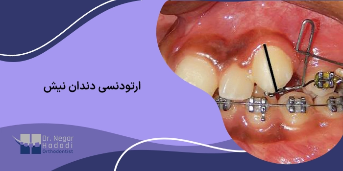 ارتودنسی دندان نیش
