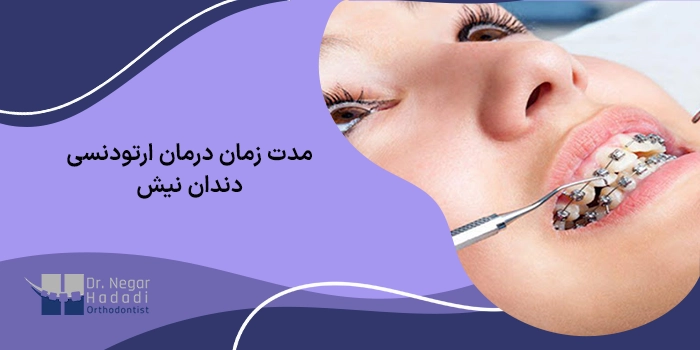 مدت زمان درمان ارتودنسی دندان نیش چقدر است؟