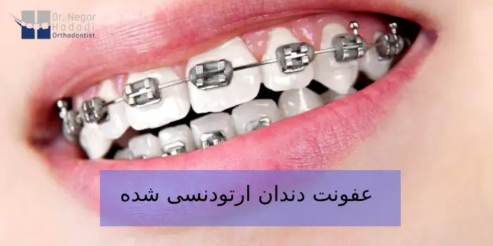 عفونت دندان ارتودنسی شده