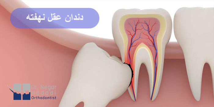 دندان عقل نهفته