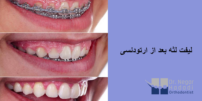 لیفت لثه بعد از ارتودنسی