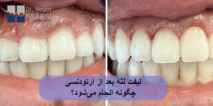 لیفت لثه بعد از ارتودنسی چگونه انجام میشود؟
