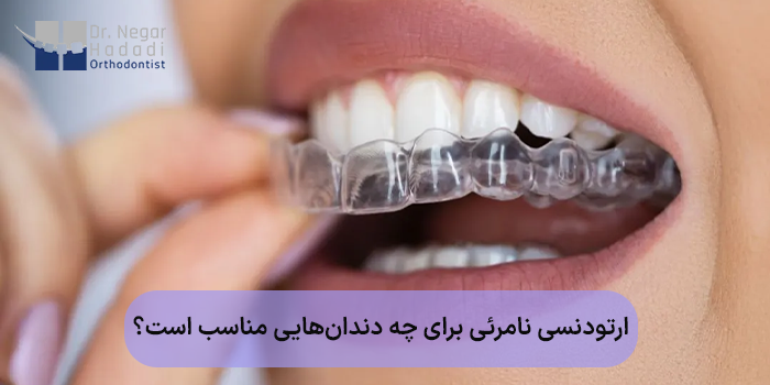 ارتودنسی نامرئی برای چه دندانهایی مناسب است؟