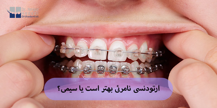 ارتودنسی نامرئی بهتر است یا سیمی؟