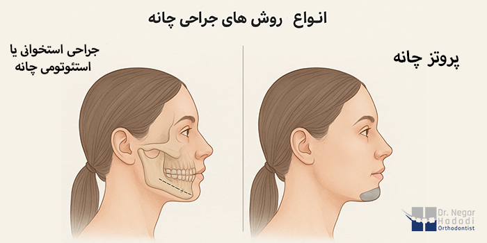 انواع روشهای جراحی چانه