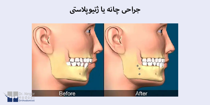 جراحی چانه یا ژنیوپلاستی